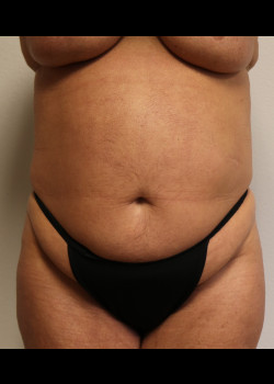 Abdominoplasty