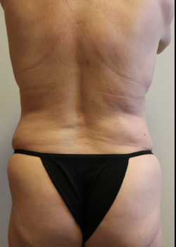 Breast Lift without Augmentation – Case 3