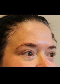 After Image: Brow Lift - other