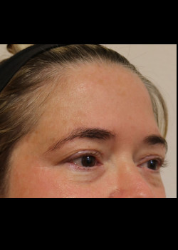 Before Image: Brow Lift - other
