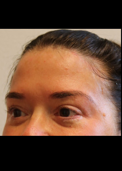 After Image: Brow Lift - other