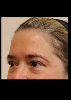 Before Image: Brow Lift - other