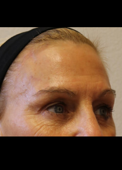 After Image: Brow Lift - other