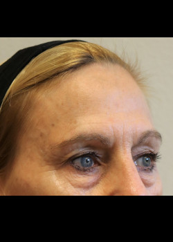 Before Image: Brow Lift - other
