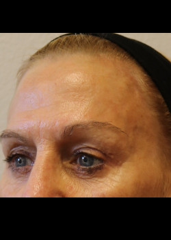 After Image: Brow Lift - other