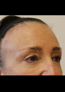 After Image: Brow Lift - other