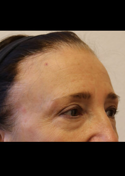 Before Image: Brow Lift - other