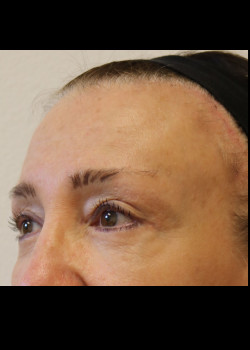 After Image: Brow Lift - other