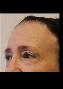 Before Image: Brow Lift - other