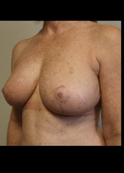 Breast Reconstruction – case 20