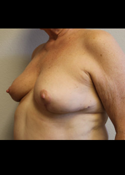 Breast Reconstruction – Case 21