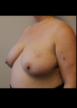 Breast Reconstruction – Case 22