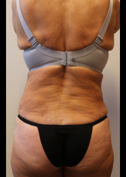 Supplies for Body Contour Surgery: Abdominoplasty, Body Lift