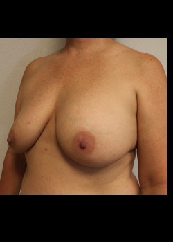 Ruptured Breast Implant – Case1
