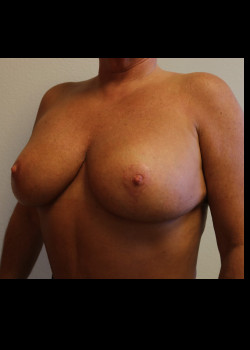 Ruptured Breast Implant – Case 3