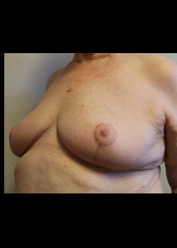 Ruptured Breast Implant – Case 5