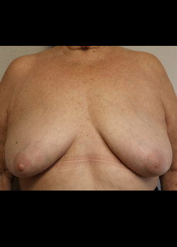 Ruptured Breast Implant