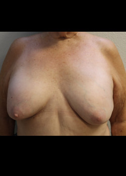 Ruptured Breast Implant