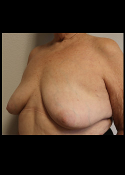 Ruptured Breast Implant – Case 6
