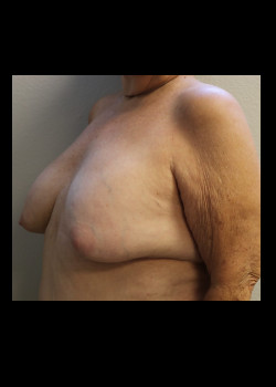 Ruptured Breast Implant