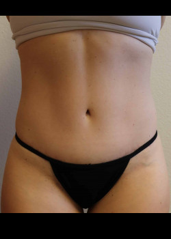 Abdominoplasty