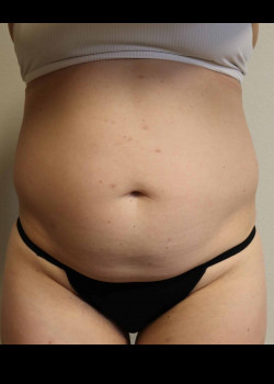 Abdominoplasty