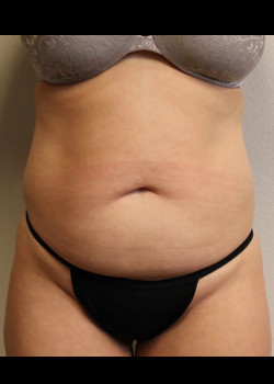 Abdominoplasty